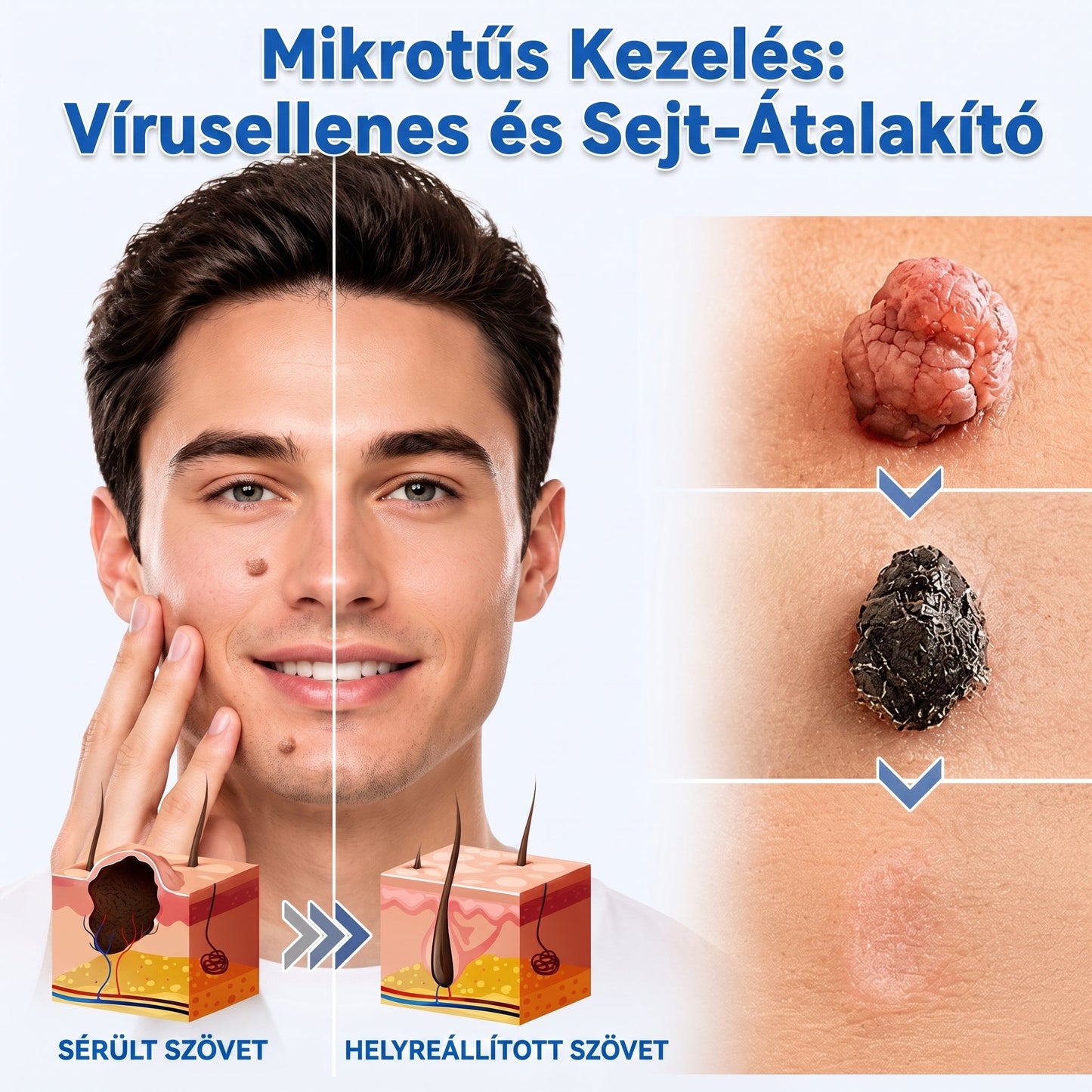 ✨PuraCure® 2 az 1-ben mikrotűs és hidrokolloid tapasz🍀 | Kiálló anyajegyek, aknék, lapos szemölcsök és bőrnövedékek eltávolítására | Segít csökkenteni a ráncokat, hegeket és bőrhibákat | Láthatatlan tapasz az arcra és testre